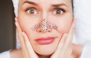 پوست بینی بعد از جراحی