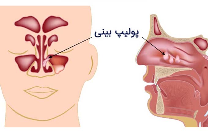 پیشگری از پولیپ و انحراف بینی