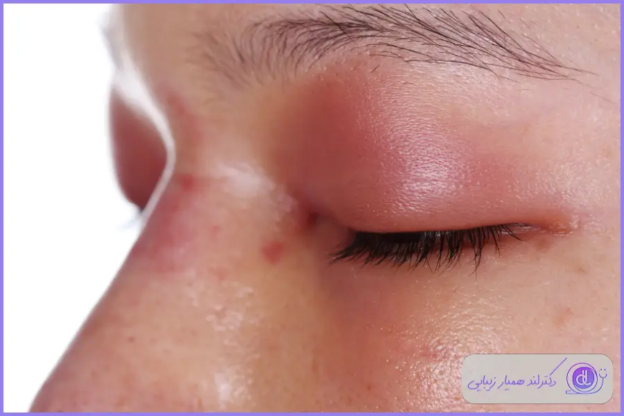 عوارض بخور دادن به روشی اشتباه بعد از جراحی بینی