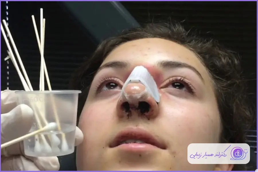 شستشوی بینی بعد از عمل: راه حلهای تأیید شده + 7 اشتباه وحشتناک! نحوه تمیز کردن بینی بعد از عمل بینی
