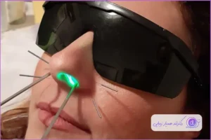 آیا طب سوزنی بینی را کوچک می‌کند؟