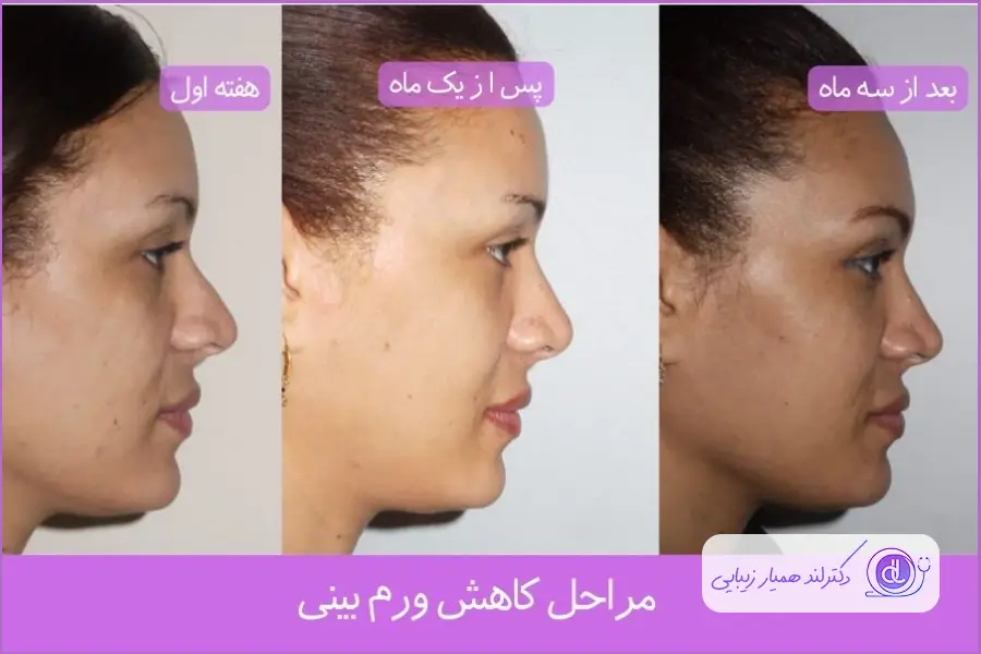 مراحل رفع ورم بینی پس از ۳ ماه