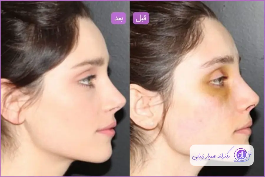 از بین رفتن ورم بینی بعد از ۵ ماه 