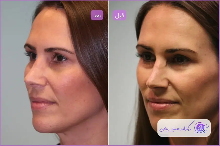 مزایا و معایب تزریق کورتون به بینی گوشتی
