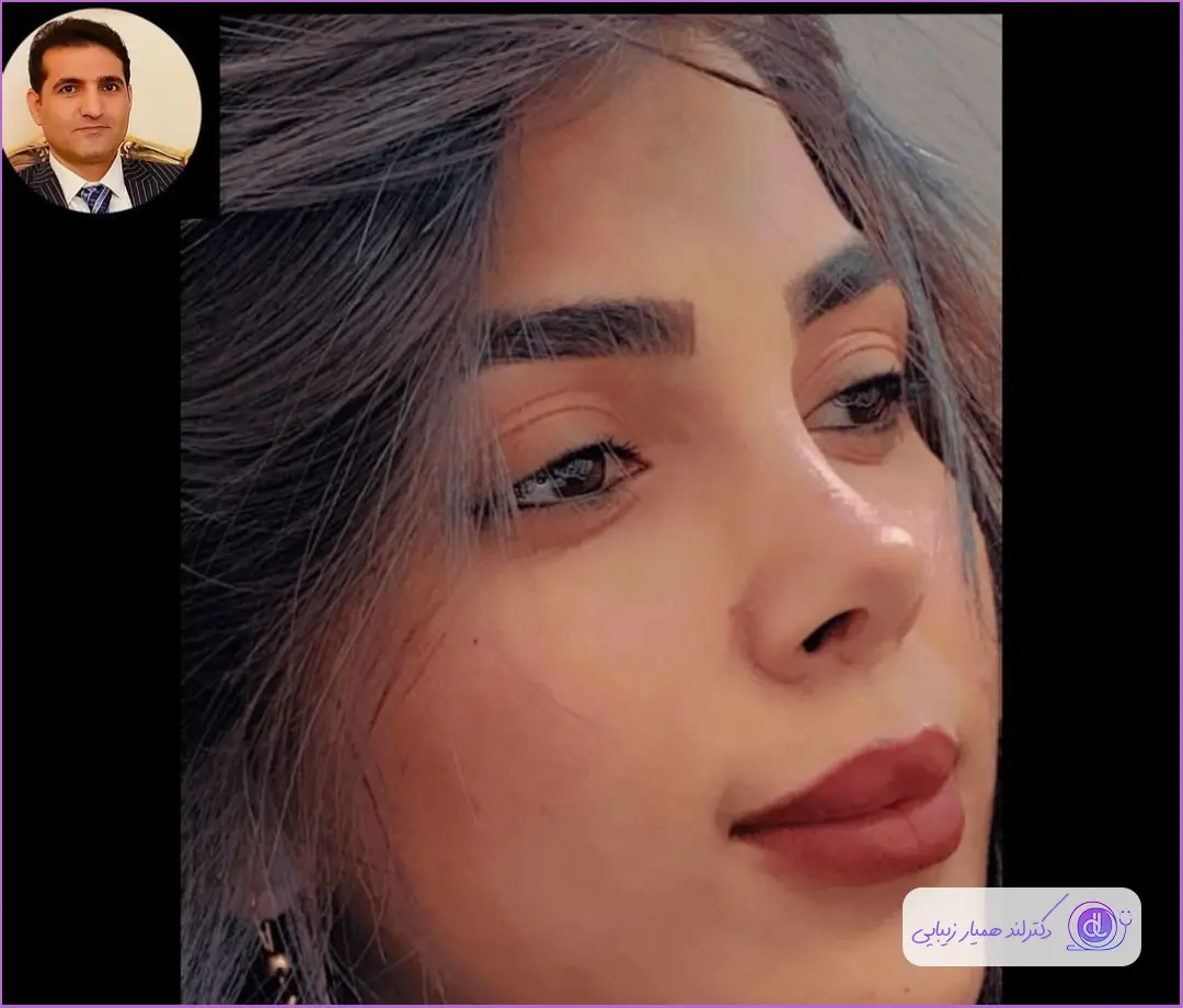 هزینه عمل بینی خوکی ۱۴۰۳