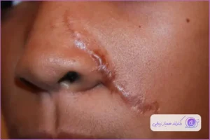 گوشت اضافه بعد از عمل بینی