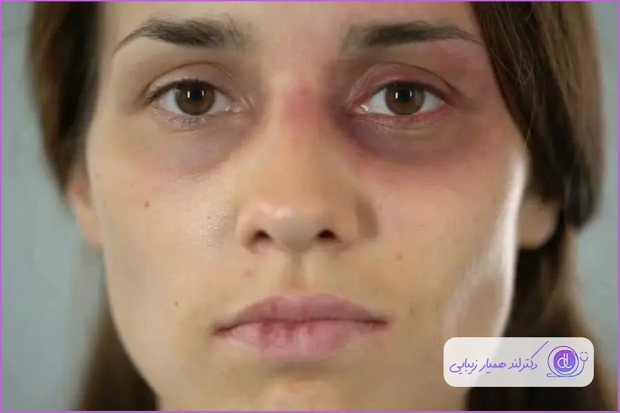 تا چه مدت اجازه برقراری رابطه جنسی بعد از عمل بینی را نداریم؟ | بررسی دقیق