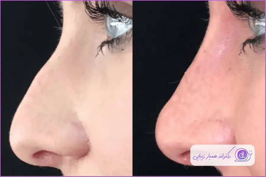 سوهان کشی بینی برای کاهش سایز دماغ