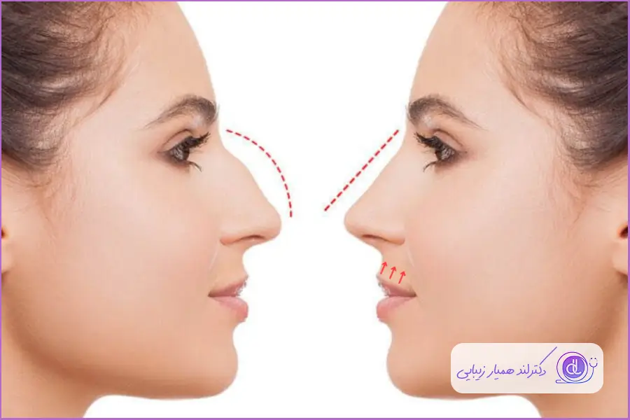 انتخاب فرم بینی زیبا با روش نسبت ریاضی