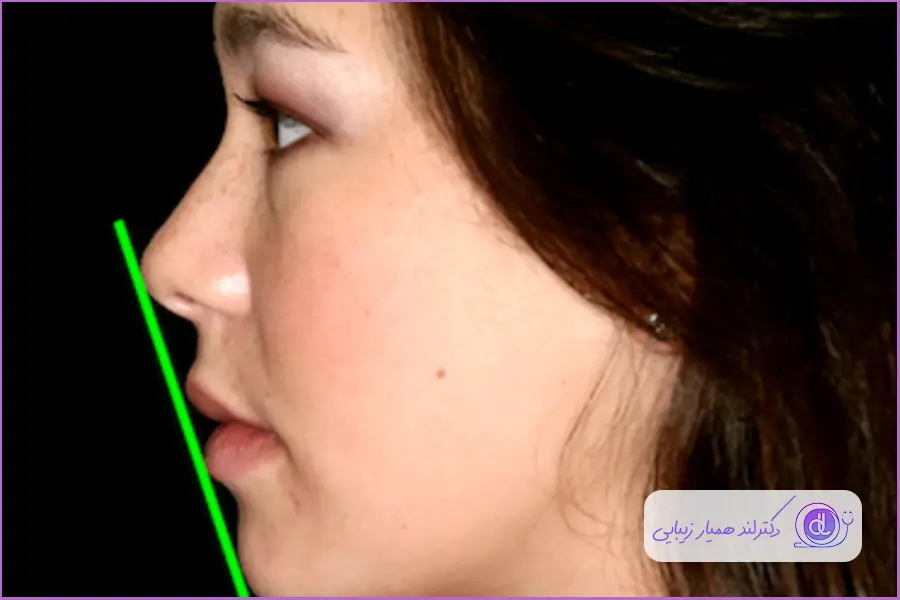 مناسب ترین زاویه برای بهترین فرم بینی زنانه