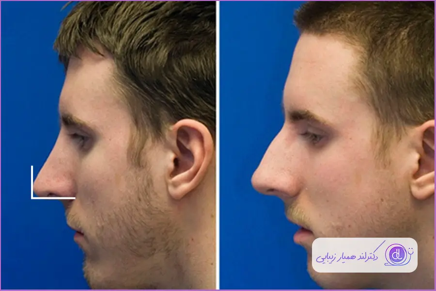 بهترین زاویه برای فرم بینی مردانه