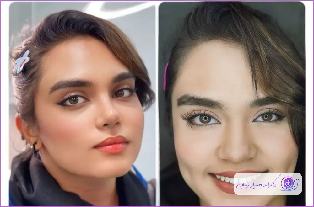 تناسب بین چهره و مدل دماغ عملی برای داشتن بینی زیبا