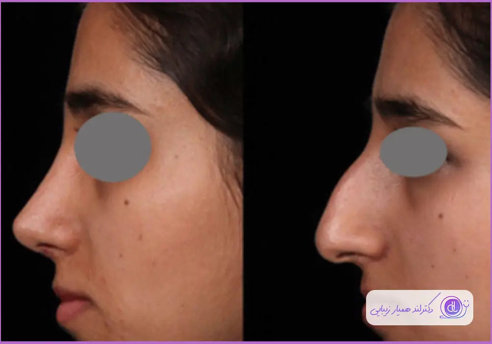 تغییرات لازم برای رسیدن به بینی زیبا