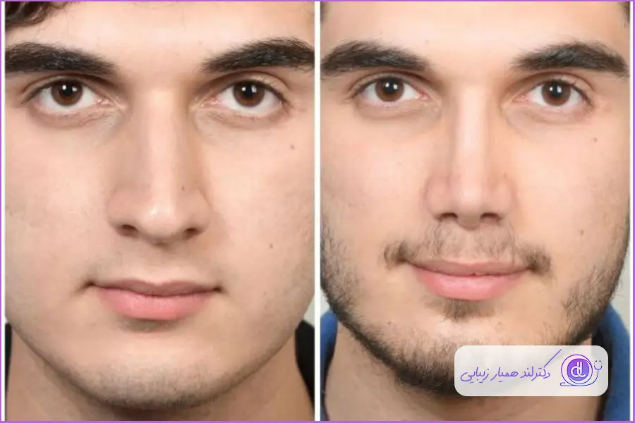 خط کانتور بینی در عمل بینی طبیعی