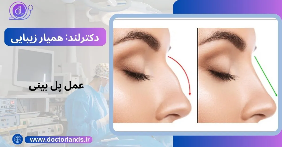 پل بینی چیست؟ | انواع پل بینی + علت فرورفتگی پل بینی و روش درمان عمل پل بینی