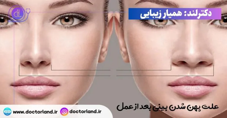 علت پهن شدن بینی بعد از عمل