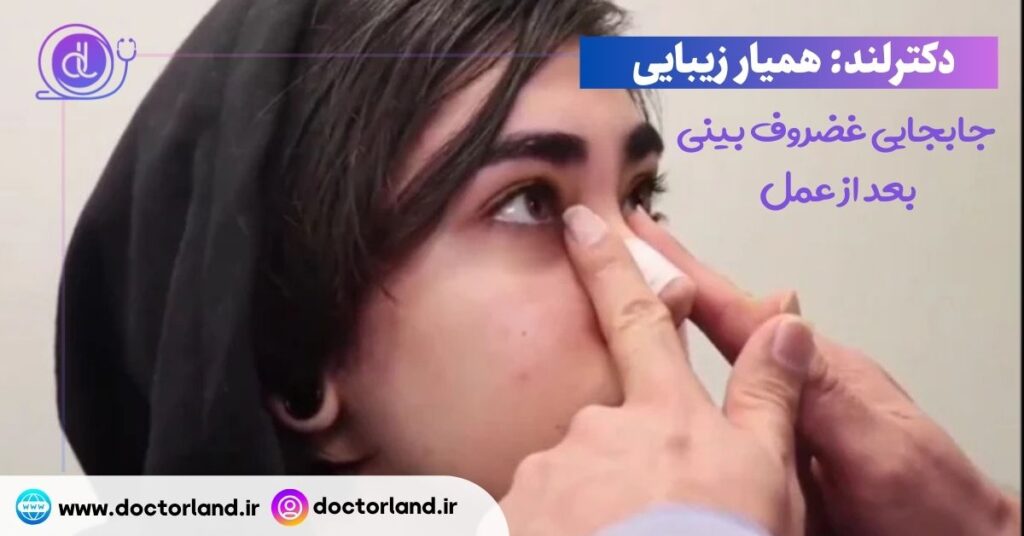 جابجایی غضروف بینی بعد از عمل