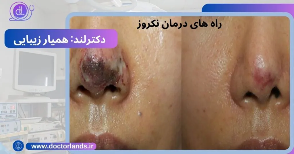 نکروز بعد از عمل بینی| از علت تا علائم + 5 راه درمان نکروز راه های درمان نکروز بعد از عمل بینی