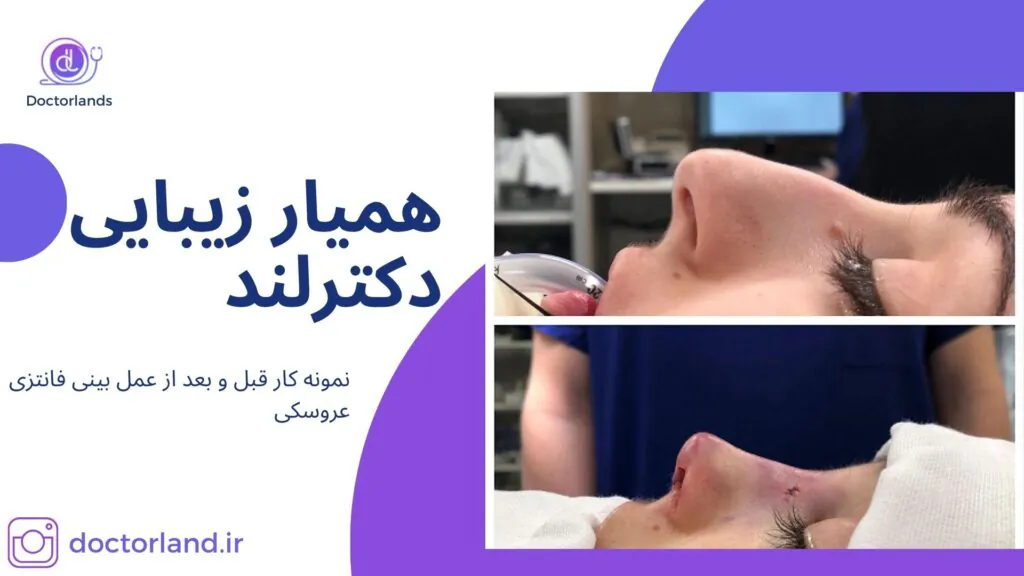 تمام نکات تفاوت عمل بینی فانتزی و نیمه فانتزی: کدام یک را انتخاب کنیم؟