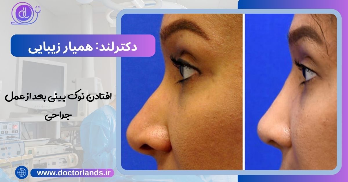 افتادن نوک بینی بعد از عمل جراحی | دلایل افتادگی نوک بینی