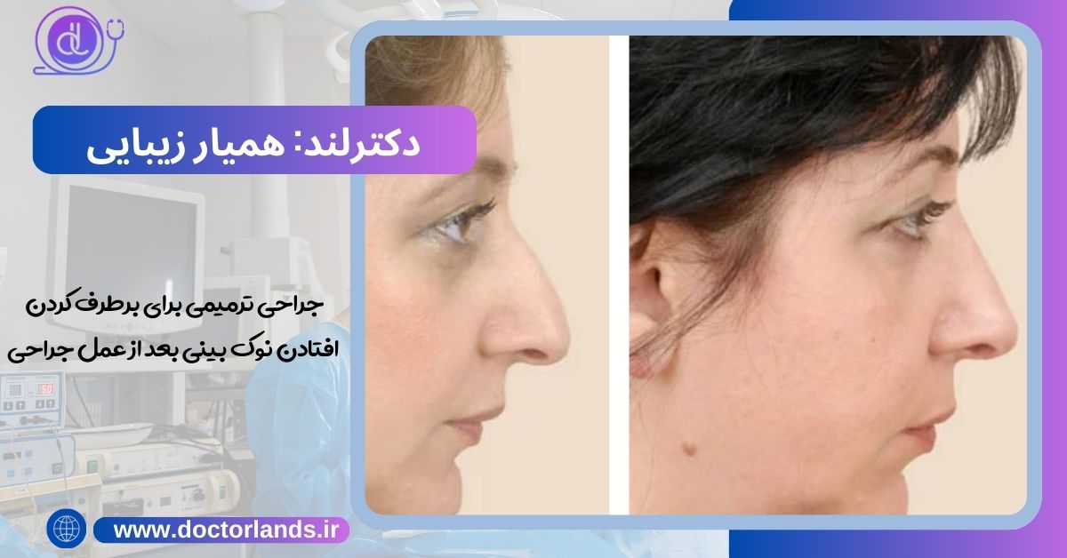 افتادن نوک بینی بعد از عمل جراحی | دلایل افتادگی نوک بینی