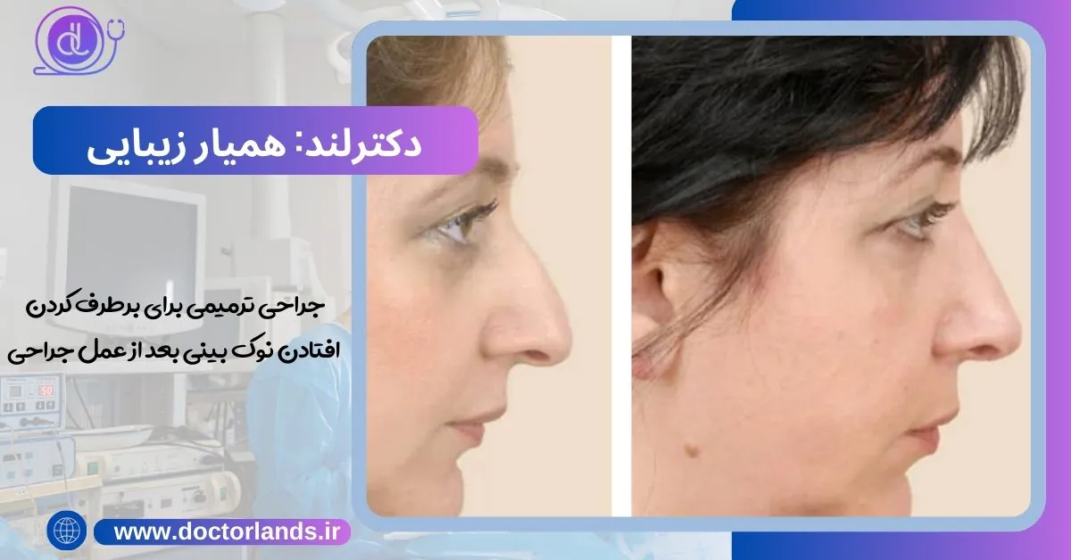 افتادن نوک بینی بعد از عمل جراحی | دلایل افتادگی نوک بینی