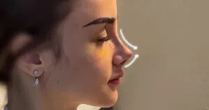 نمونه ای از عمل بینی خوکی