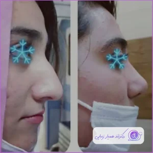خشکی دهان بعد از عمل بینی