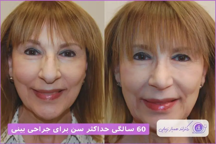 حداکثر سن عمل بینی
