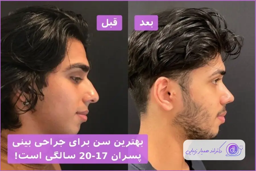 سن عمل بینی پسران