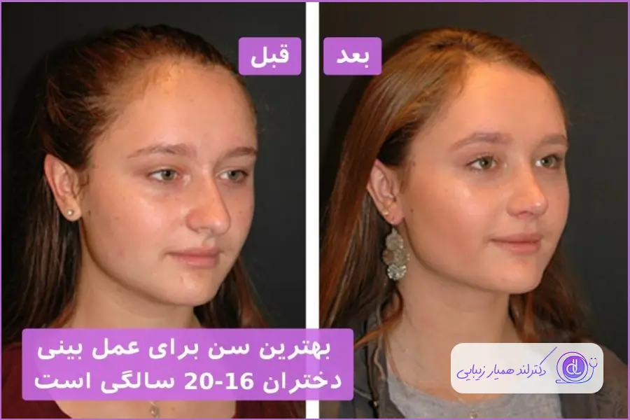 بهترین سن عمل بینی | بررسی بهترین سن عمل بینی برای پسران و دختران بهترین سن عمل بینی برای دختر