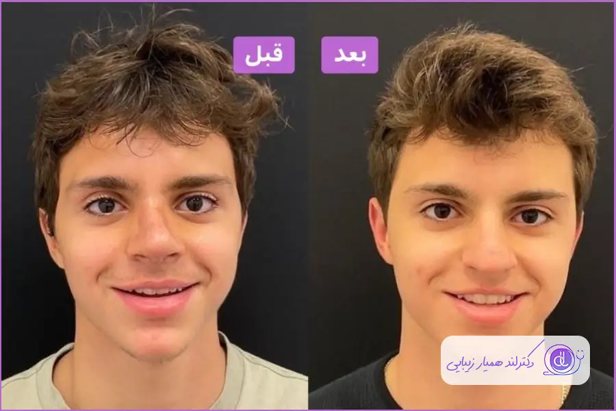 بهترین سن عمل بینی گوشتی