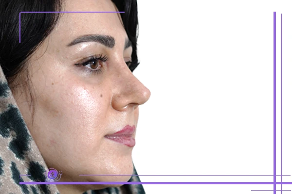 عمل بینی طبیعی