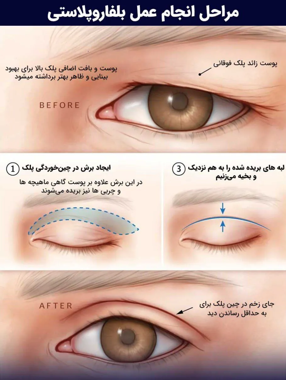 مراحل انجام جراحی بلفاروپلاستی