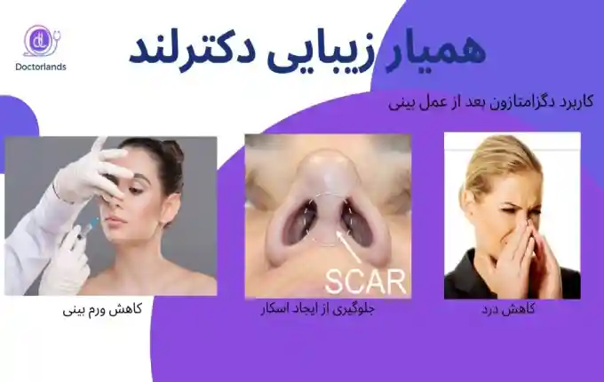 دگزامتازون بعد از عمل بینی