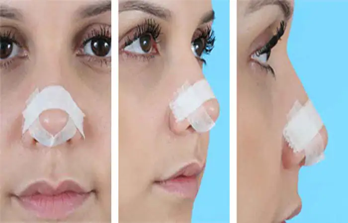 نحوه چسب زدن بینی بعد از عمل
