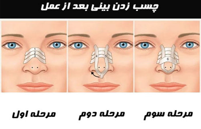 نحوه چسب زدن بینی پس از جراحی بینی