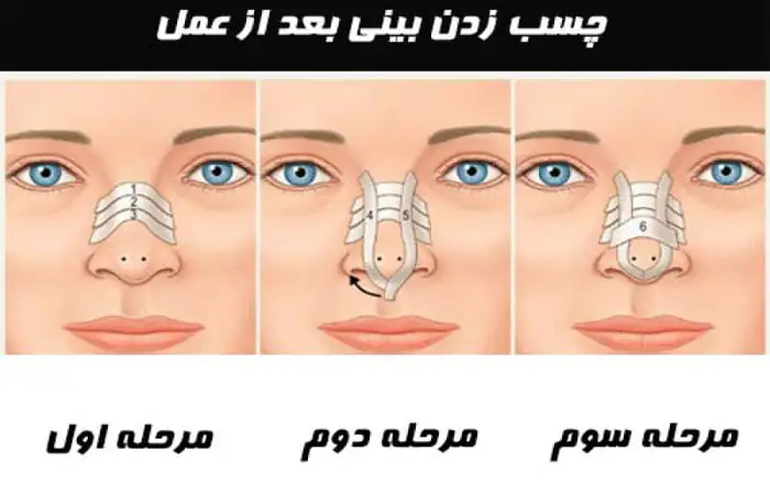 نحوه چسب زدن بینی پس از جراحی بینی