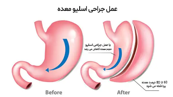 عمل اسلیو معده یا گاسترکتومی اسلیو