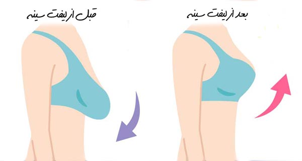 پروتز زیبایی سینه