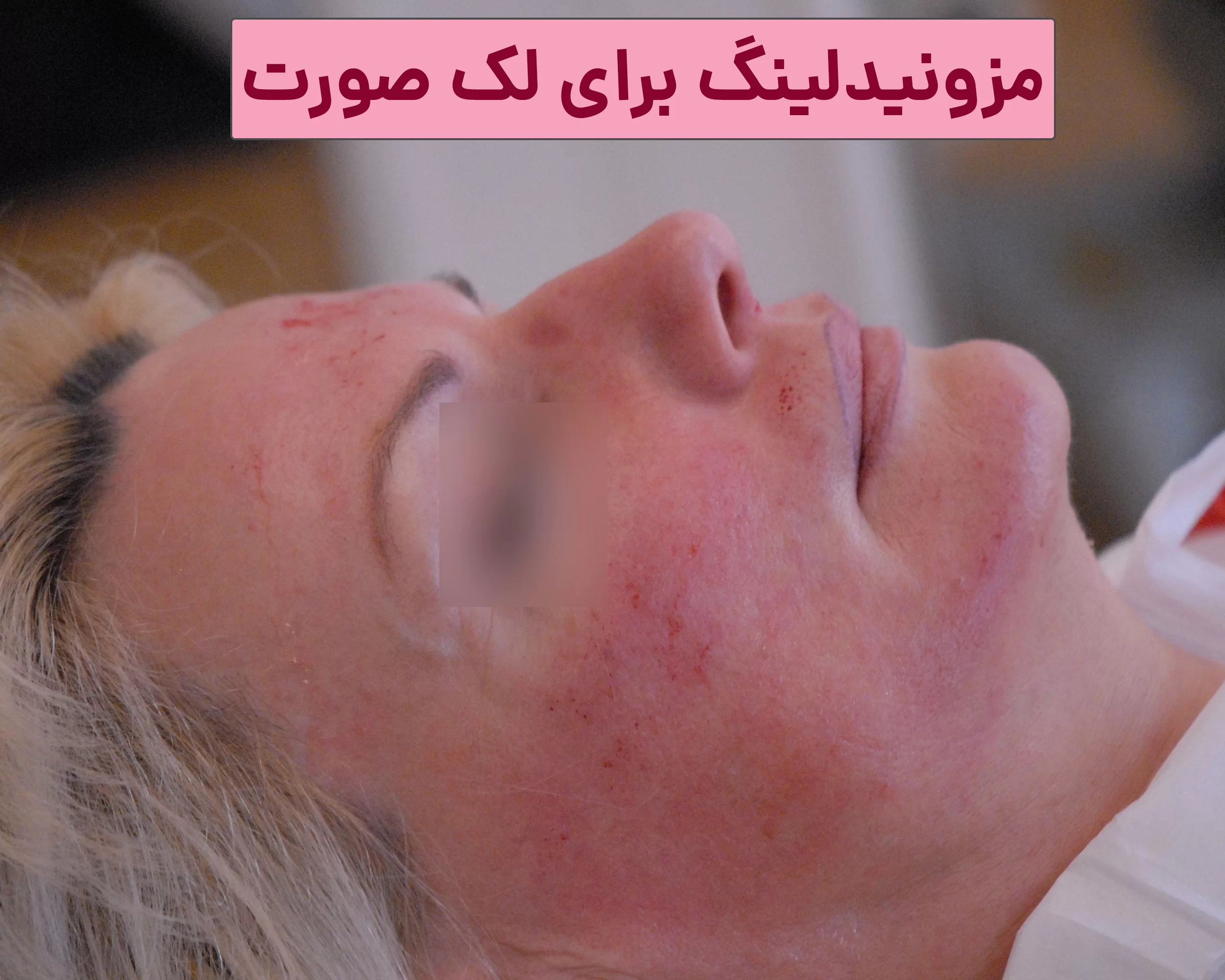 مزونیدلینگ
