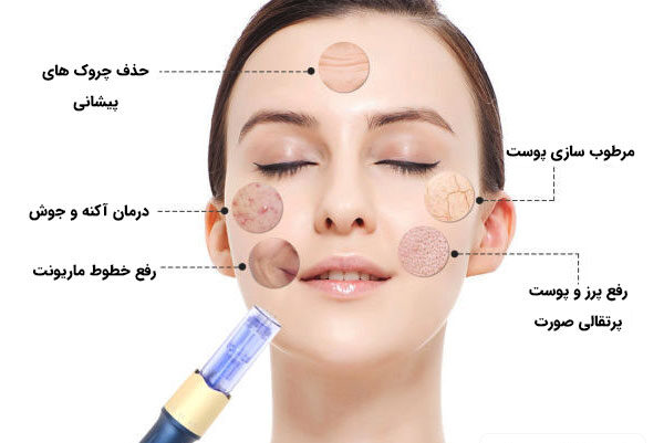 میکرو نیدلینگ