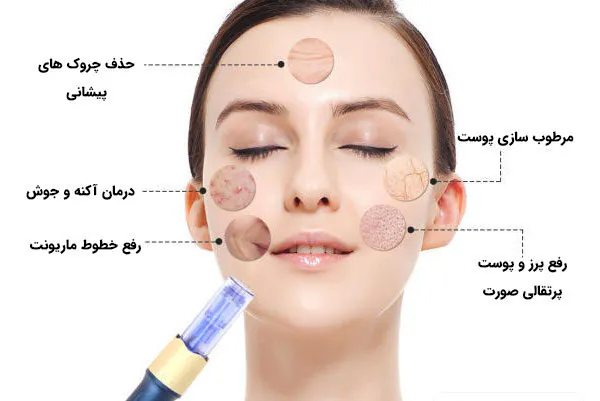 میکرو نیدلینگ
