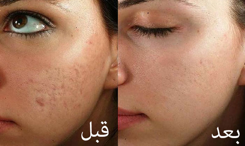 مزونیدلینگ