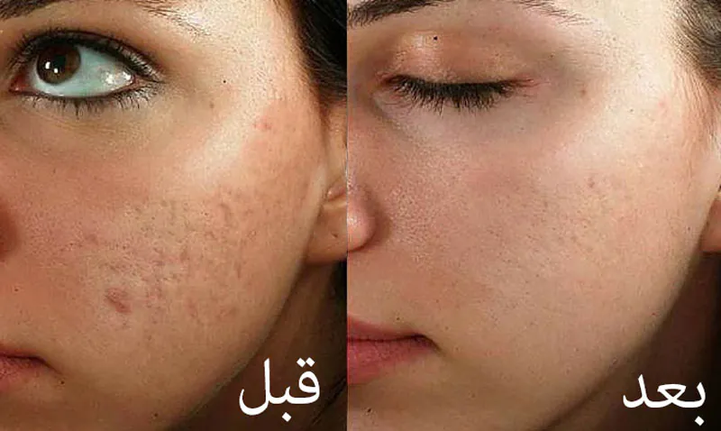 مزونیدلینگ