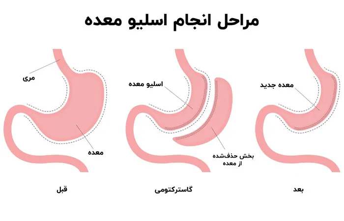 عمل اسلیو معده یا گاسترکتومی اسلیو