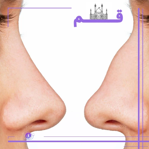 عمل بینی در قم و انتخاب بهترین جراح بینی