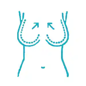 ماموپلاستی
