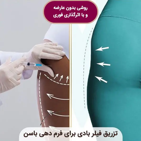 فیلر برای بادی