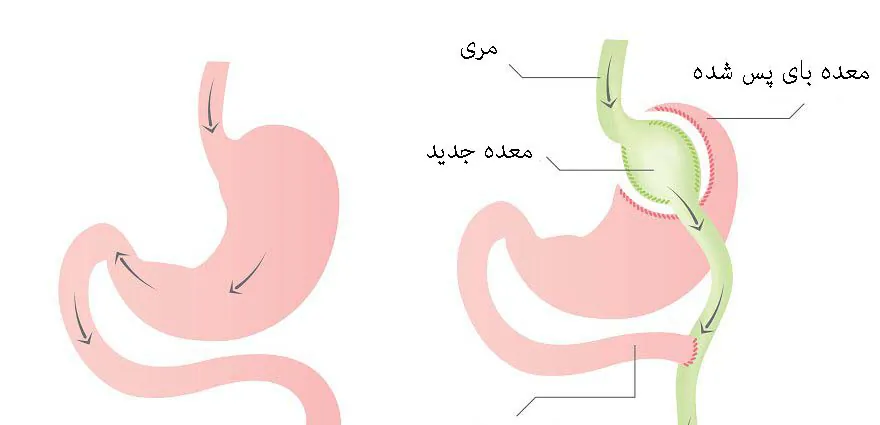 جراحی بای پس معده
